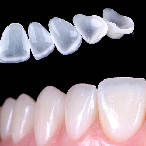 E.max Estetik Restorasyonlar