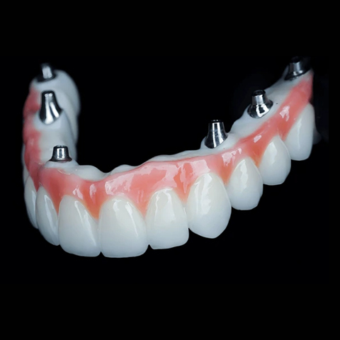 İmplant Üstü Protez Çözümleri